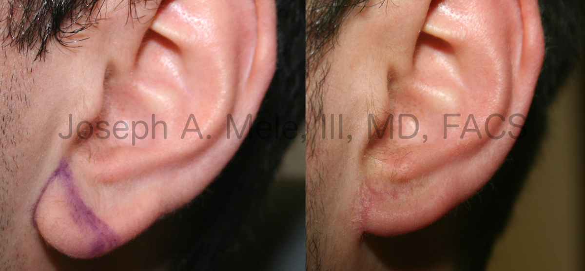 Earlobe Reduction before and after pictures