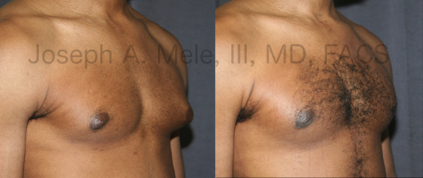 Gynecomastia Reduction before and after pictures (male breast reduction surgery)