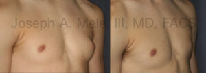 Gynecomastia Reduction before and after pictures (male breast reduction surgery)