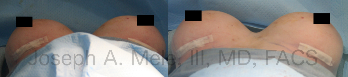 Breast Augmentation Revision before and after pictures with gummy-bear breast implants