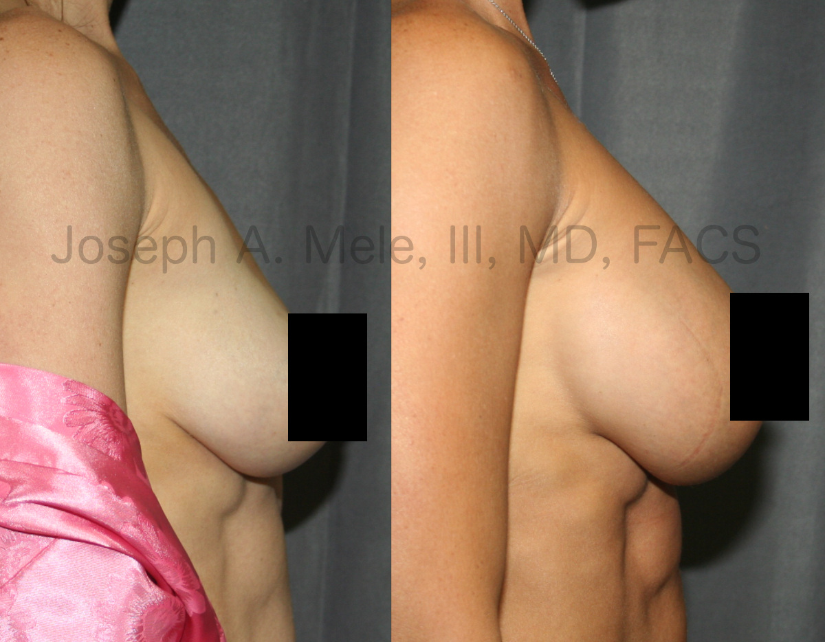 Augmentation Mastopexy (Breast Augmentation with a Breast Lift and Areola Reduction) before and after pictures