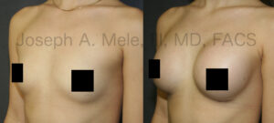 Breast Augmentation before and after pictures with gummy-bear breast implants