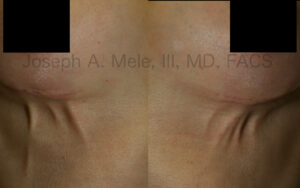 Mondor's Bands after Breast Augmentation