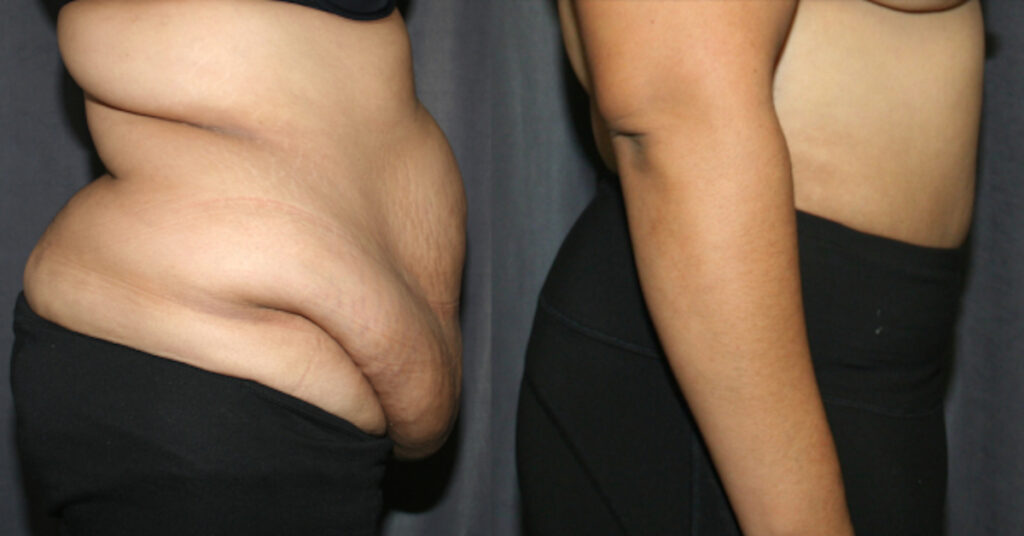 Heavy Weight Tummy Tuck - Abdominoplasty before and after pictures