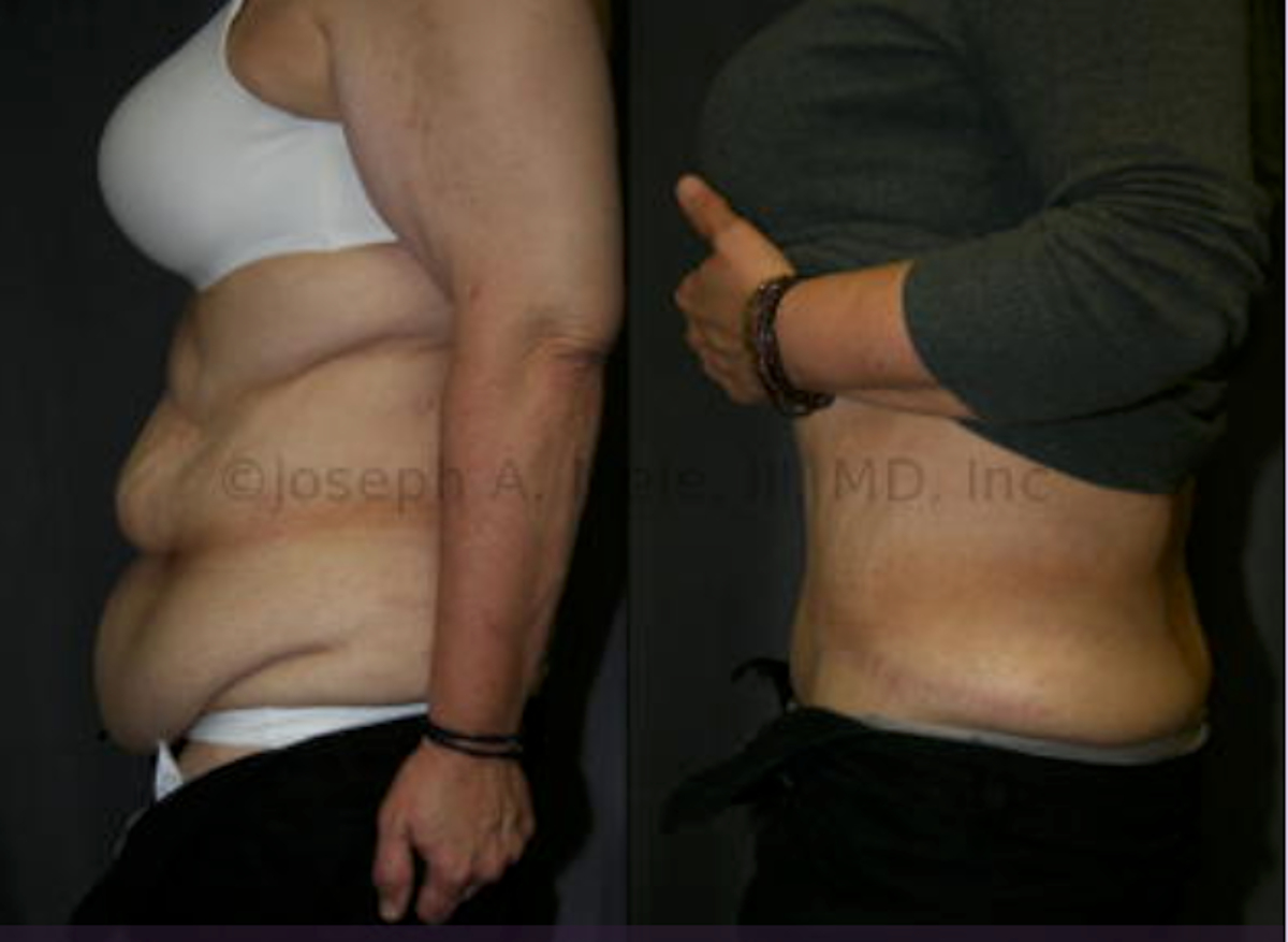 Heavy Weight Tummy Tucks - Abdominoplasty before and after pictures