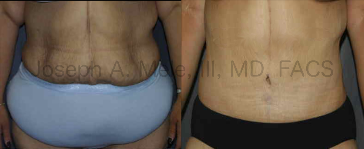 Heavy Weight Tummy Tucks - Abdominoplasty before and after pictures