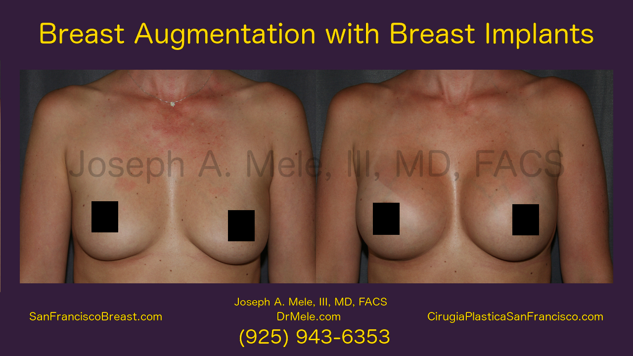 Breast Augmentation before and after video presentation