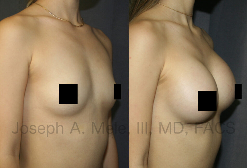 Breast Augmentation Video with before and after pictures