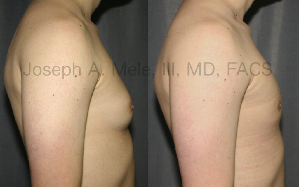 Gynecomastia reduction - side view of before and after male breast reduction