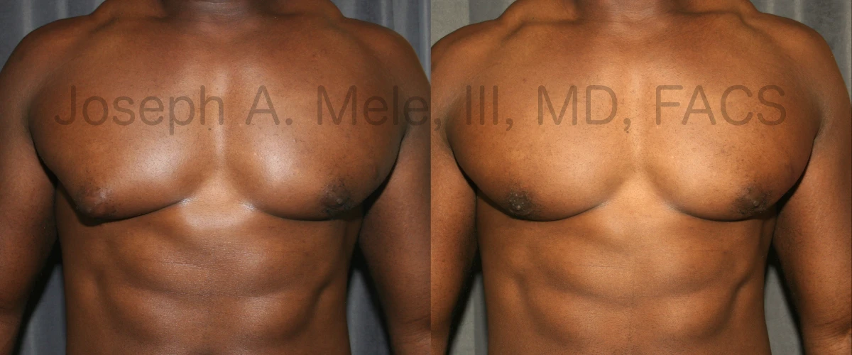 Unilateral (one sided) gynecomastia - corrected with male breast reduction surgery