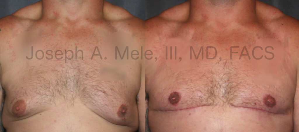 Male breast reduction with skin resection and "free-nipple" skin grafts