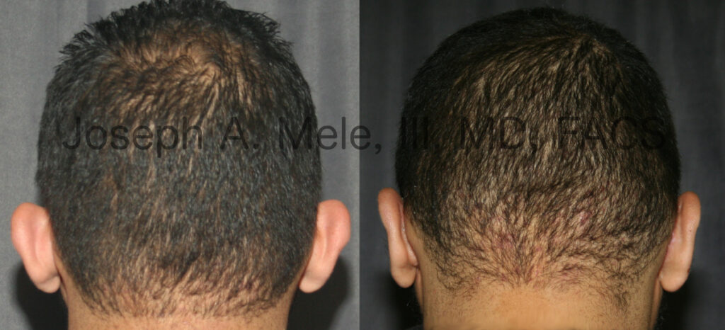 Otoplasty for men before and after pictures. Ear pinning or ears that stick out.