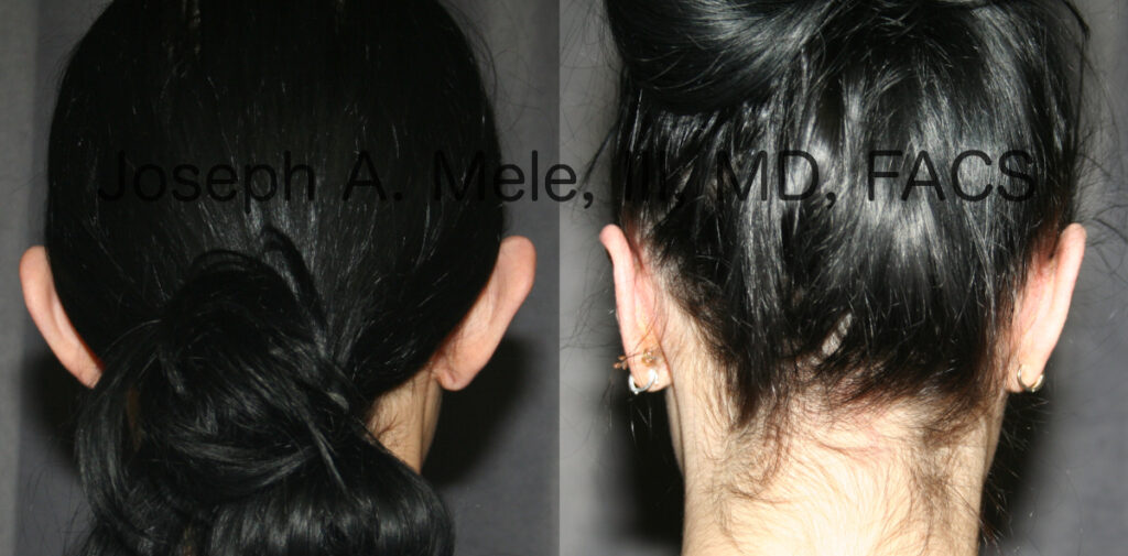 Ear pinning before and after pictures (Otoplasty for prominent ears)