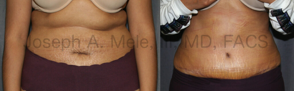 Abdominoplasty after childbirth. Tummy Tuck before and after photos