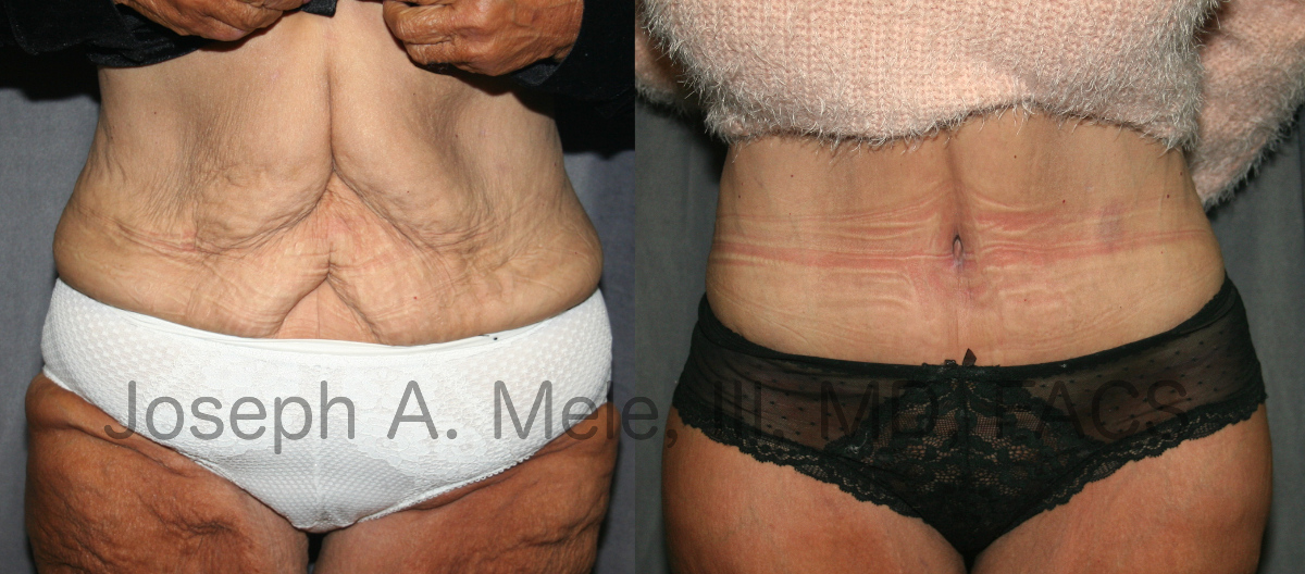 Tummy Tuck after massive weight loss - post bariatric abdominoplasty