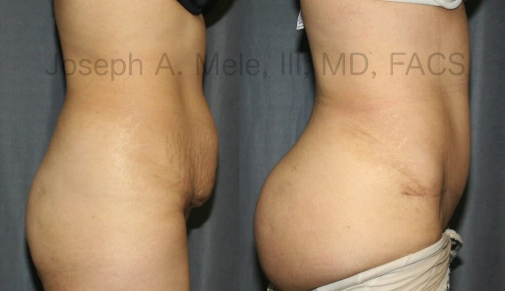 Tummy Tuck with Brazilian Buttocks Lift (BBL) before and after pictures (Tummy Tuck)