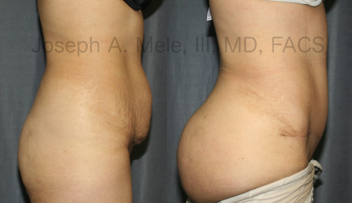 Tummy Tuck, Liposuction and Brazilian Buttocks Lift (BBL) before and after pictures (Tummy Tuck)