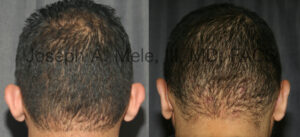 Otoplasty Video with Ear Pinning before and after pictures