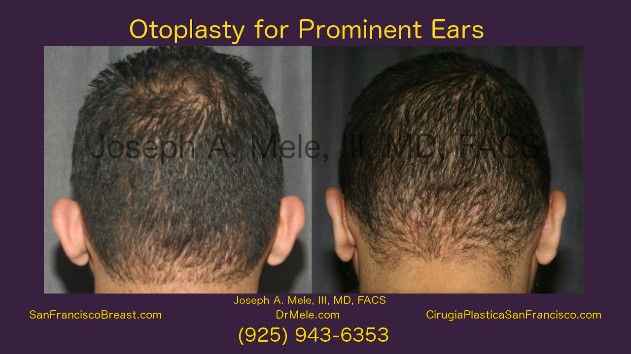 Otoplasty Video with Ear Pinning before and after pictures