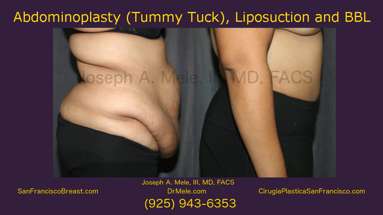 Tummy Tuck. Liposuction and BBL Video Presentation with before and after pictures