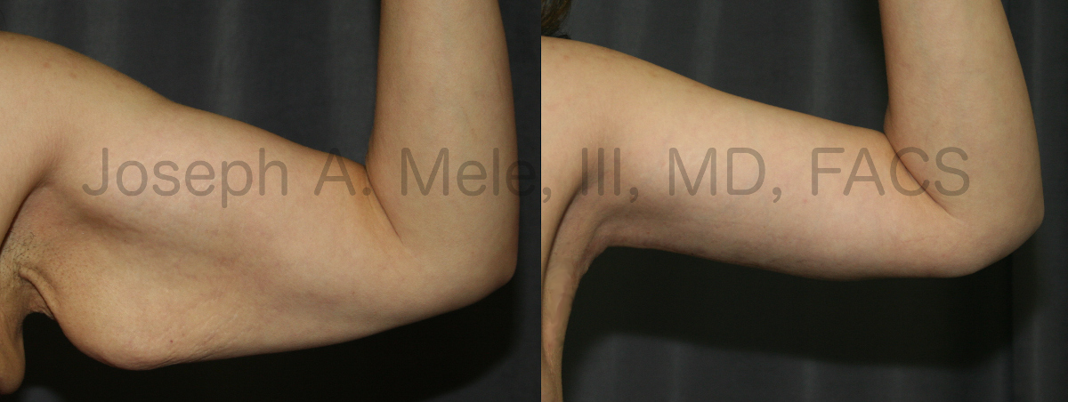 Arm Lift Before and After Pictures (Brachioplasty Photos)