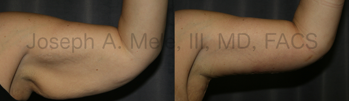 Arm Lift Before and After Pictures (Brachioplasty Photos)