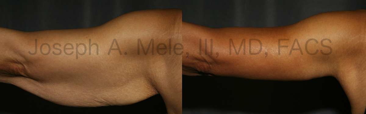 Arm Lift Before and After Pictures (Brachioplasty Photos)