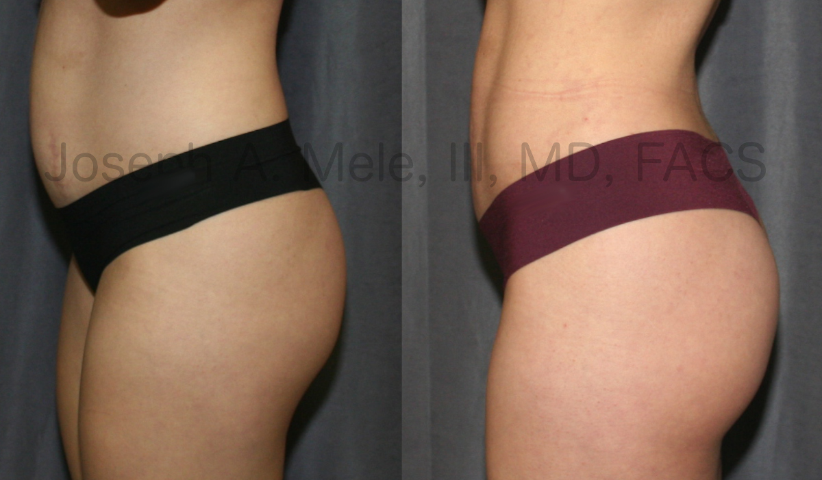 Brazilian Buttock Lifts – Buttocks Augmentation with Fat Grafting