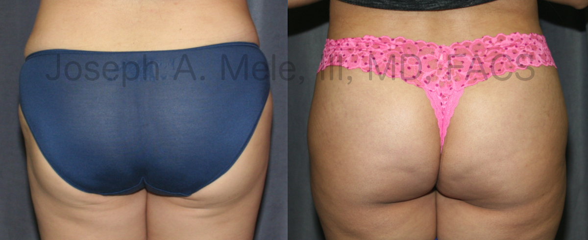 Brazilian Buttocks Lift (BBL) - Before and After Picture - Butt Lifts