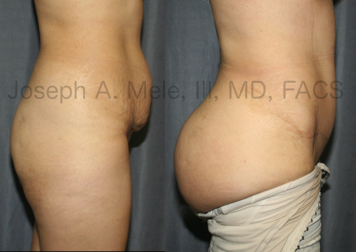 Brazilian Buttocks Lift (BBL) and Abdominoplasty - Before and After Picture - Tummy Tuck and Butt Lift