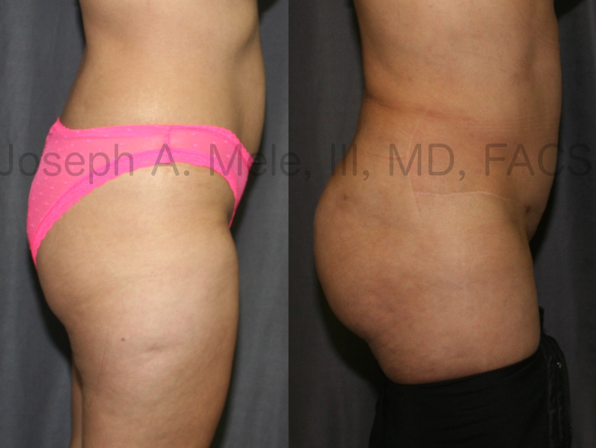 Brazilian Buttocks Lift (BBL) and Abdominoplasty - Before and After Picture - Tummy Tuck and Butt Lift