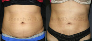 Liposuction of the Abdomen - Before and After Pictures
