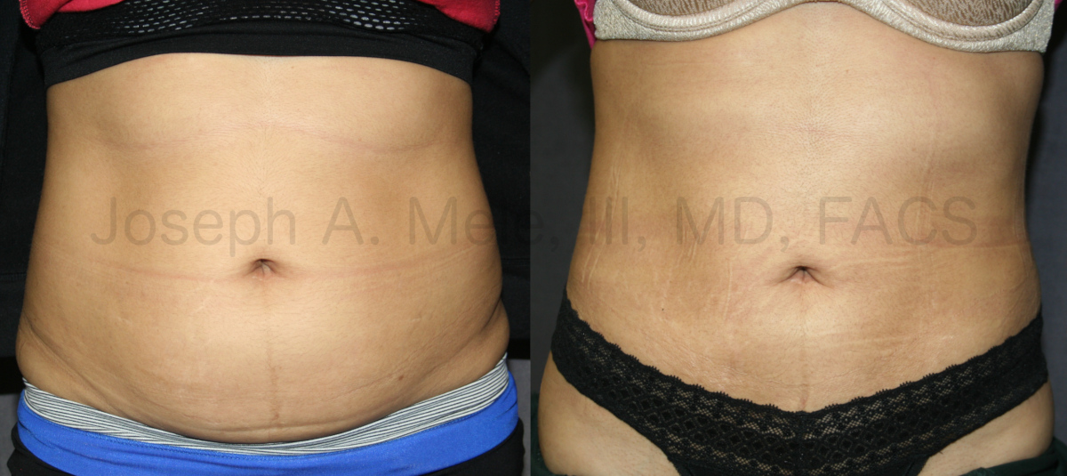 Liposculpture and Liposuction Before and After