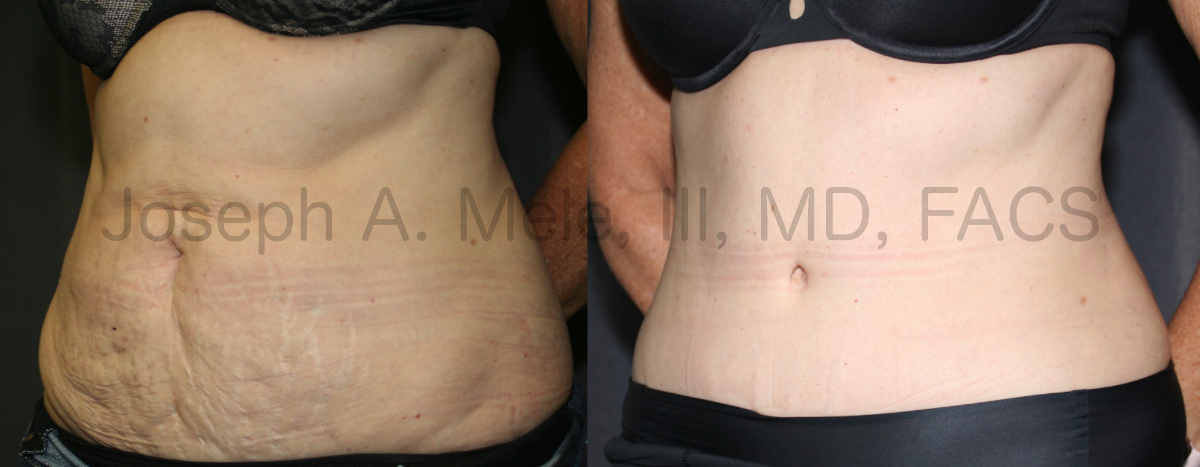 Liposuction of the flanks and back with Tummy Tuck before and after pictures