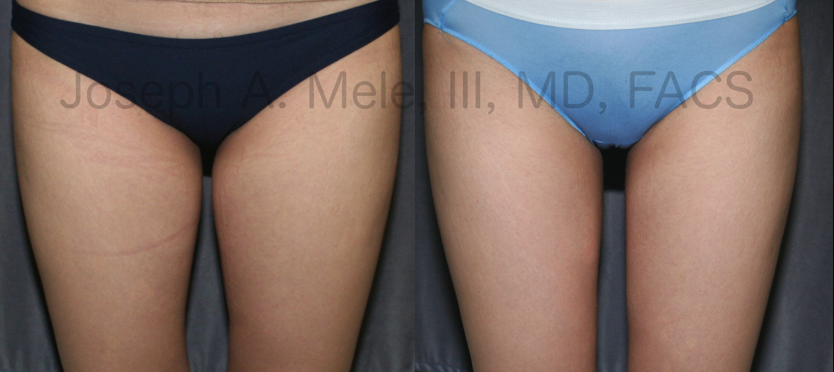 Liposuclpture of the thighs - liposuction before and after pictures