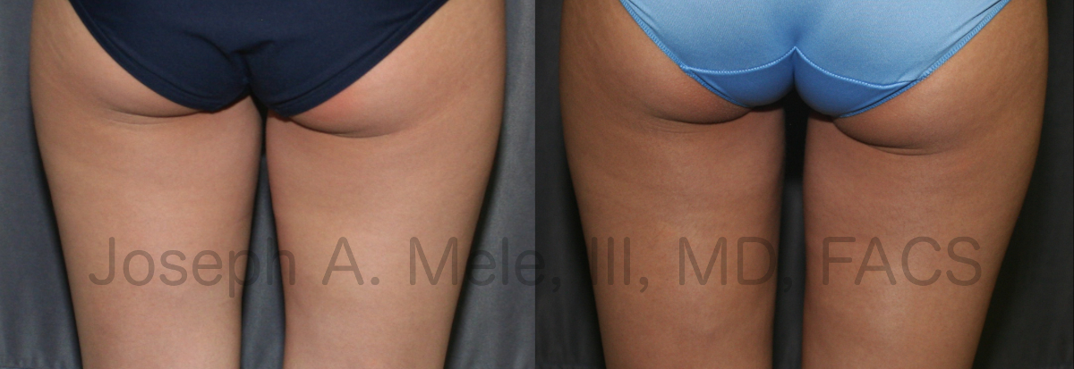 Liposuclpture of the thighs - liposuction before and after pictures