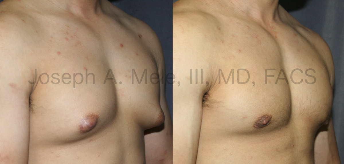 Liposuction of the chest for Gynecomastia - before and after pictures