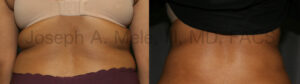 Liposuction of the back, bra folds and love handles - before and after photos
