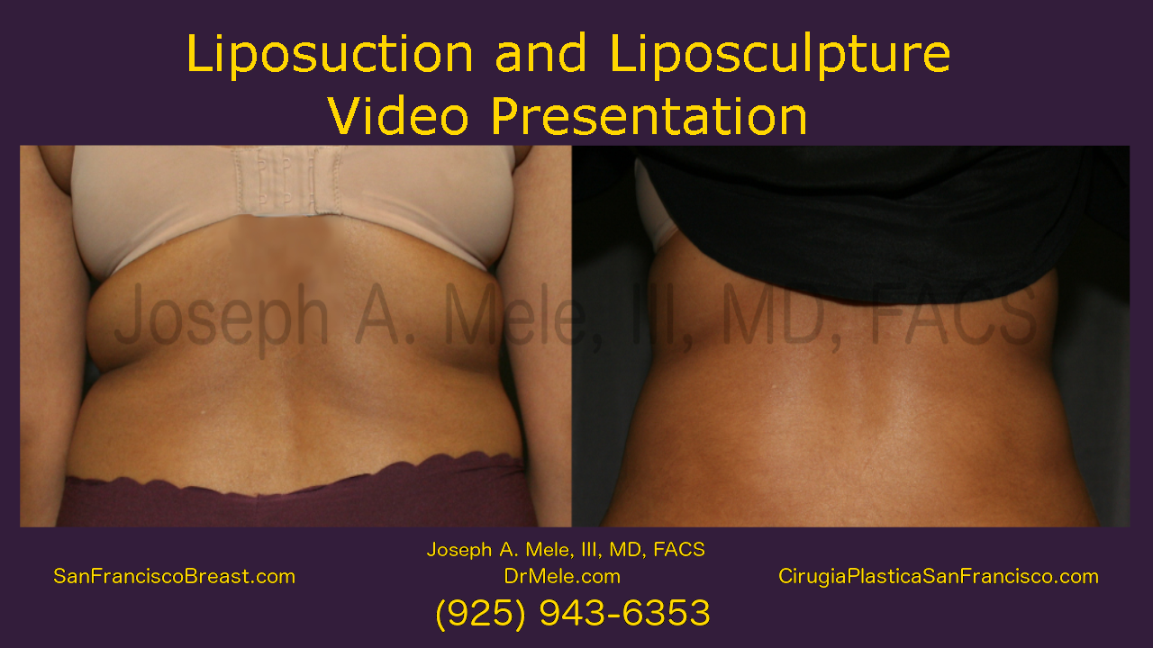 Tumescent Liposuction (Liposculpture)- with Liposuction before and after pictures