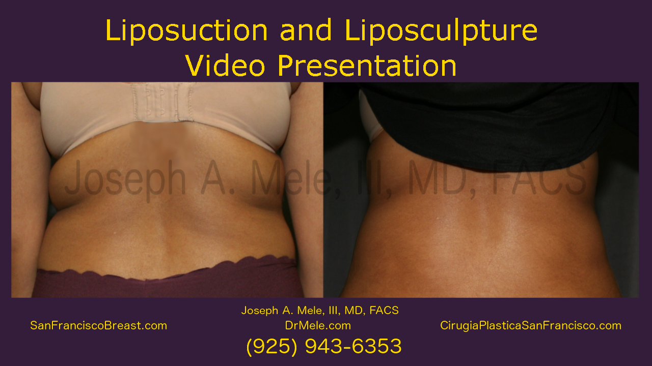 Video: Liposuction vs. Liposculpture SF Bay Area