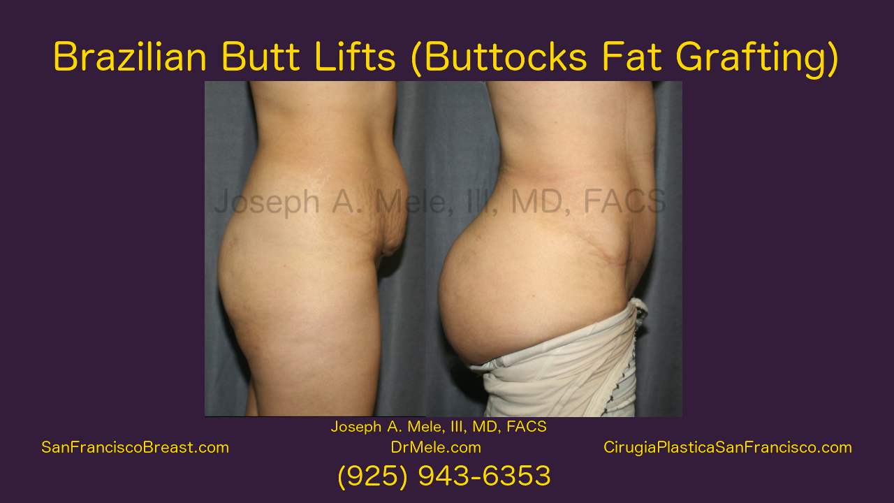 Brazilian Buttocks Lift with Tumescent Liposuction (BBL)- with BBL before and after pictures
