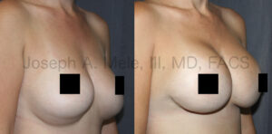 Breast Augmentation Revision Surgery for bottoming out (censored version)