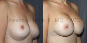 Breast Augmentation Revision Surgery for bottoming out (uncensored version)