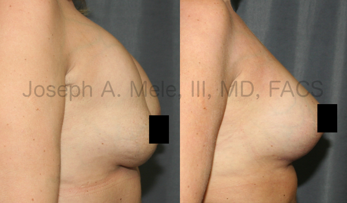 Breast Augmentation Revision Surgery with Capsulectomy and Breast Lift with a Breast Implant