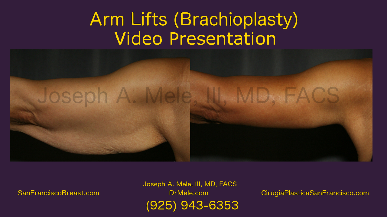 Brachioplasty video - with arm lift before and after pictures