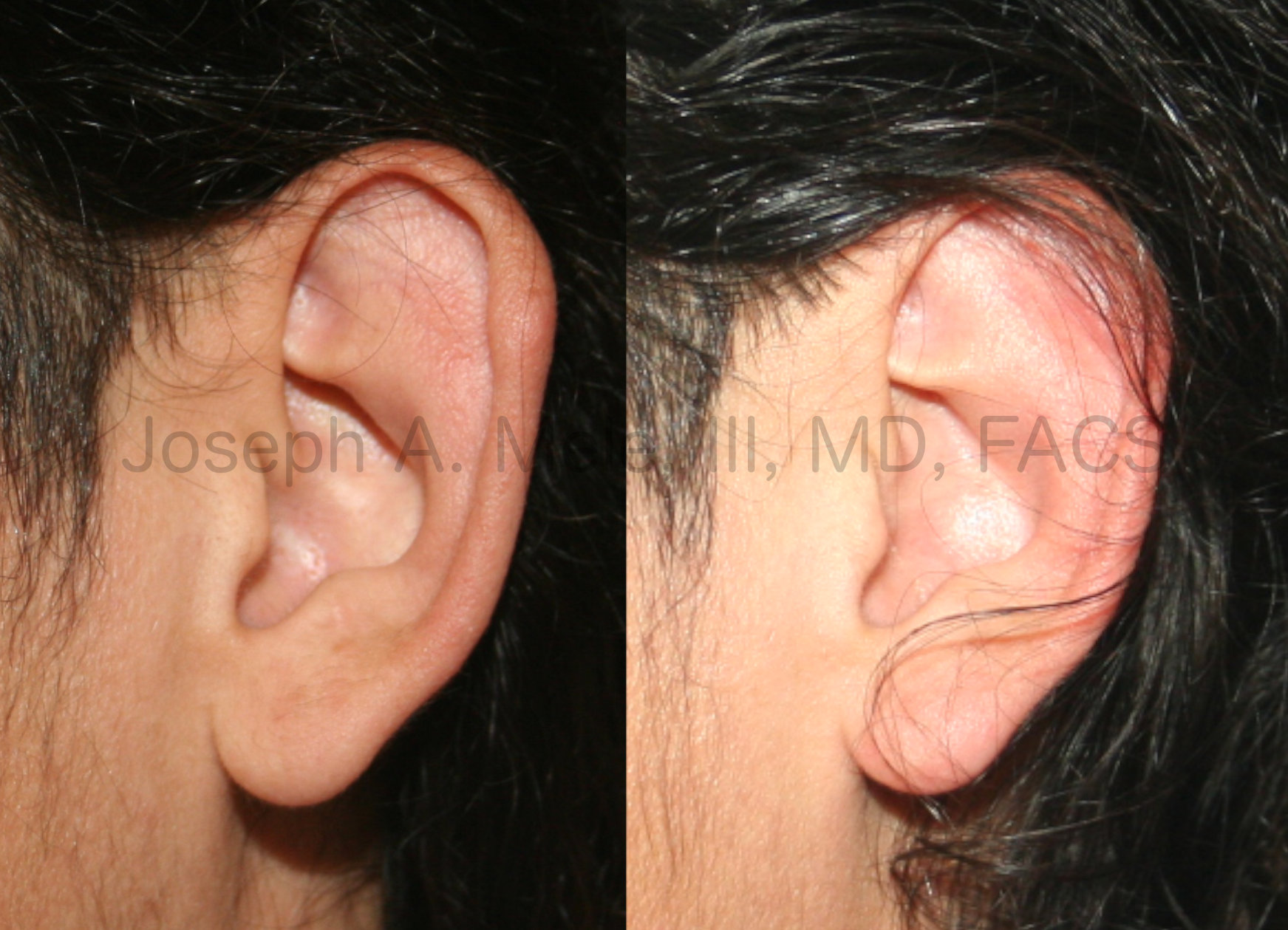 Otoplasty before and after close up of antihelical fold