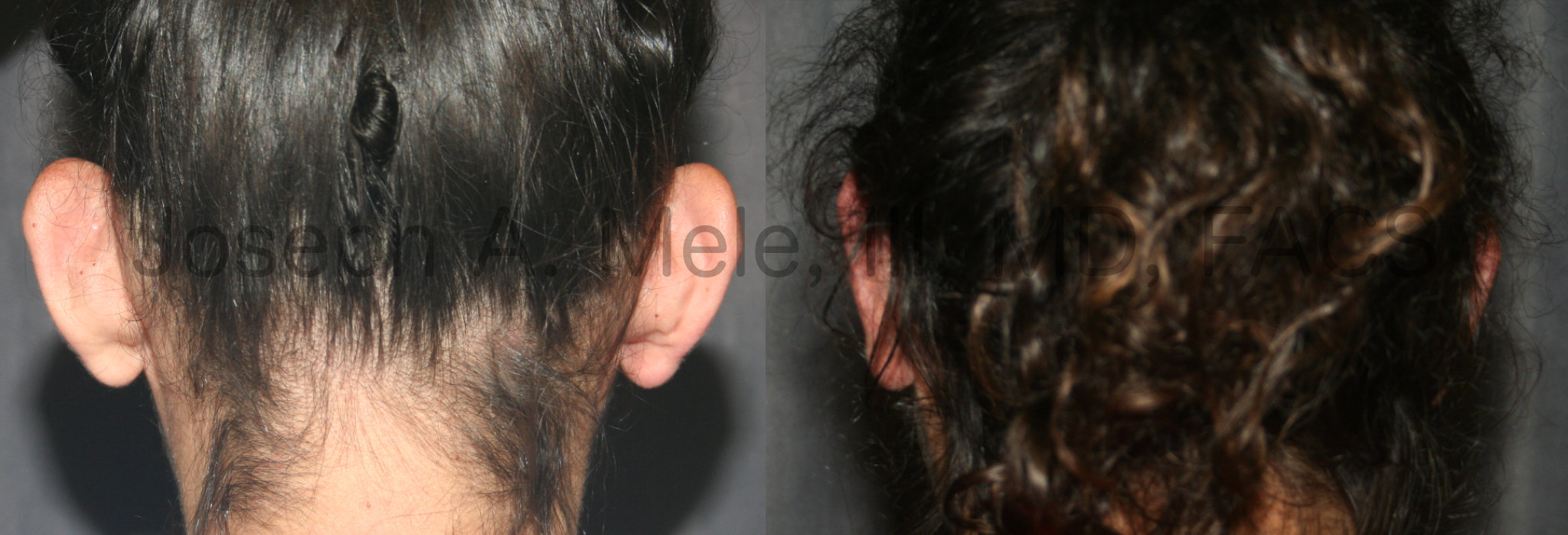 Otoplasty before and after pictures - man posterior view - prominent ear correction with plastic surgery