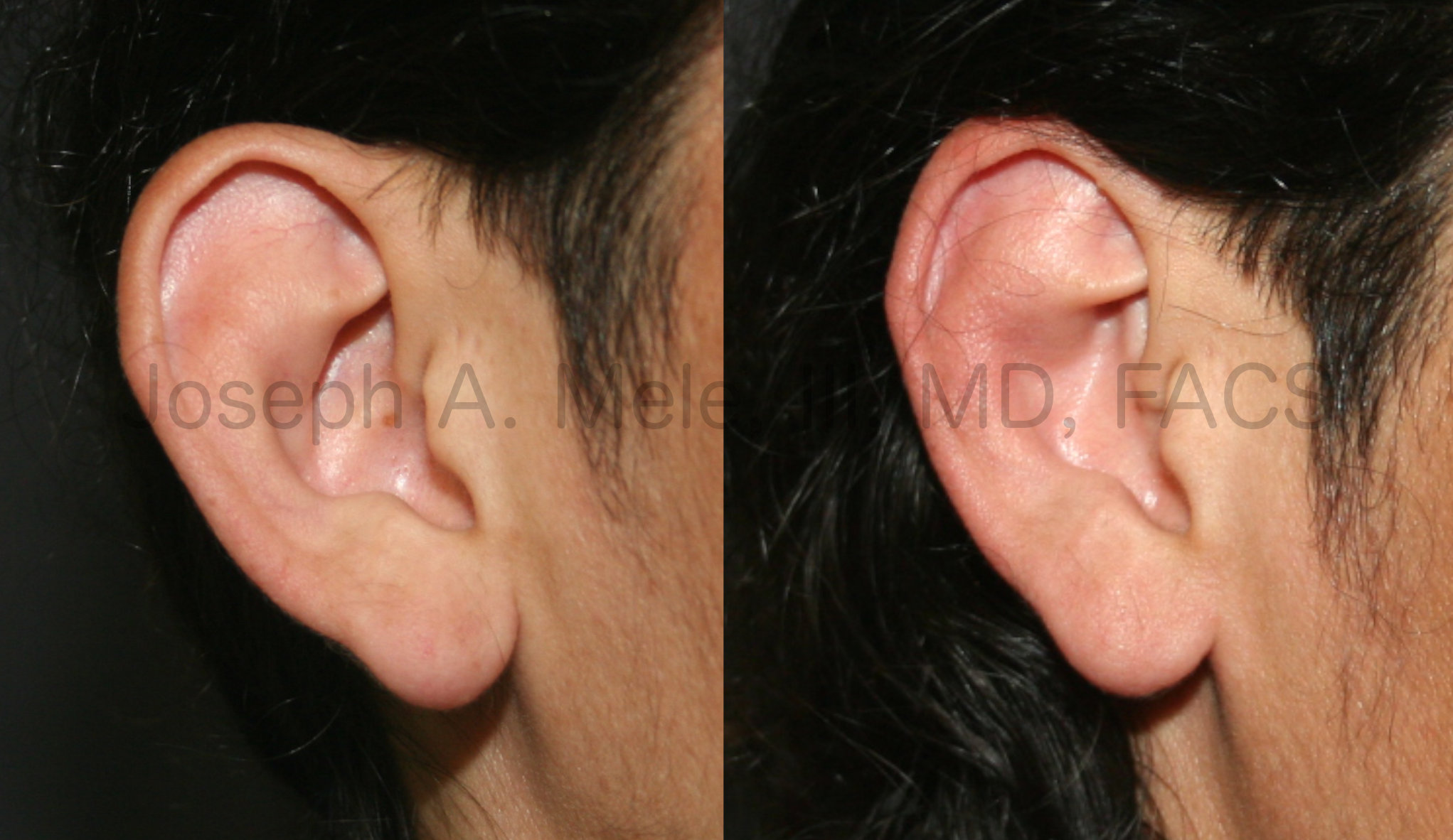 Otoplasty before and after close up of antihelical fold