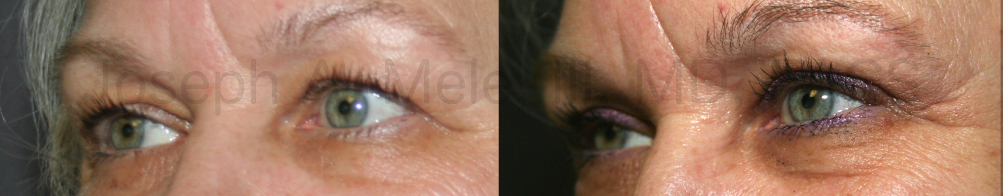 Eyelid Lift before and after pictures (Blepharoplasty)