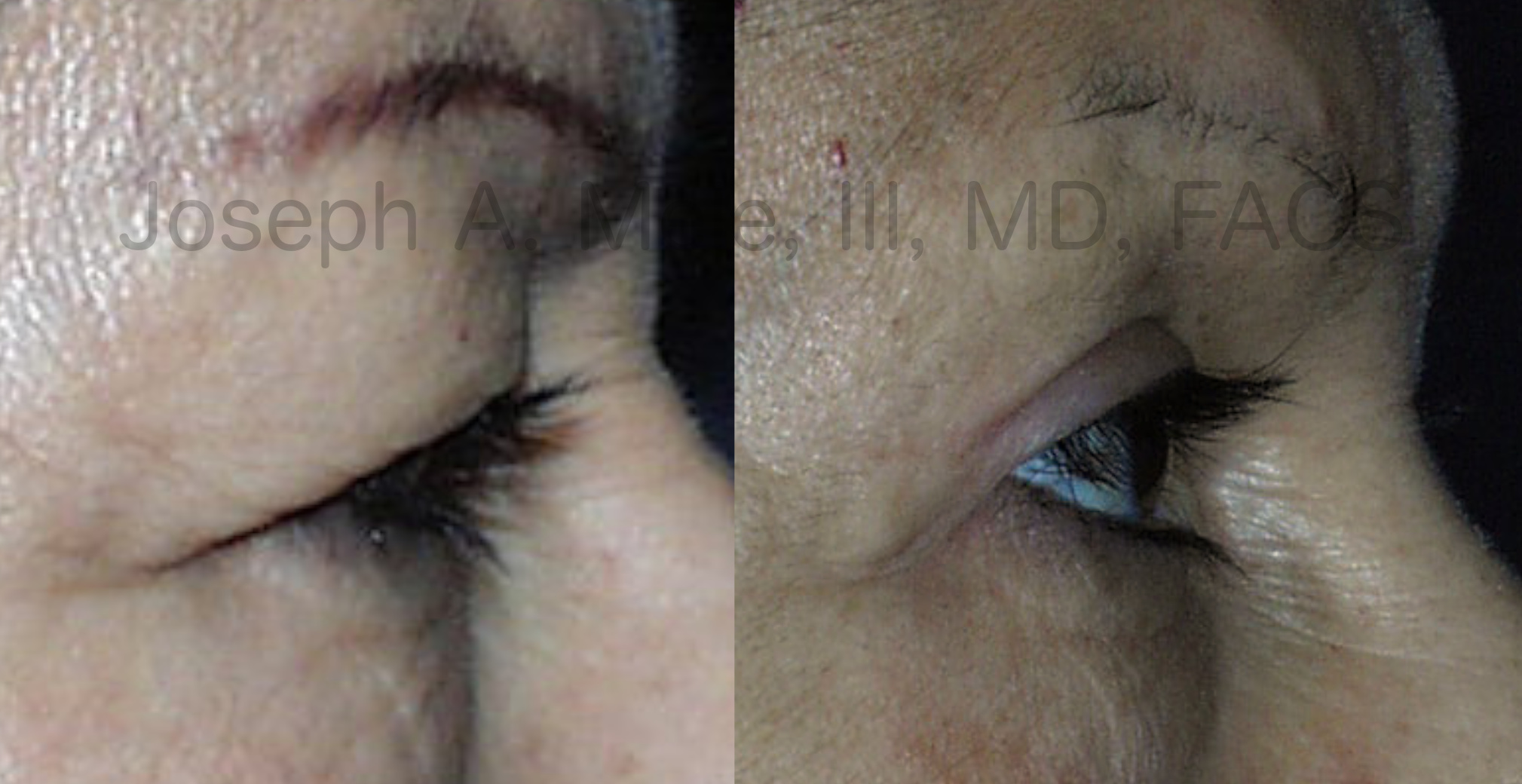 Upper Eyelid Lift before and after pictures (Blepharoplasty)